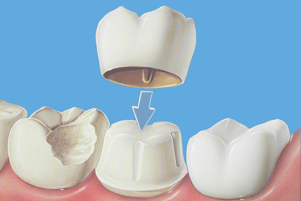 KW-Dental-Crowns