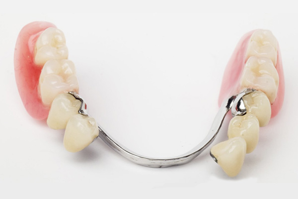 KW-Partial-Denture