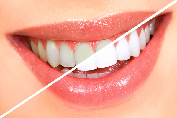 KW-Teeth-Whitening